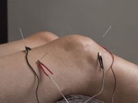 Elektro akupunktura